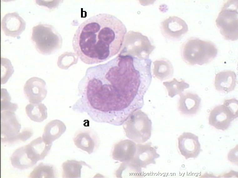 白血病外周血细胞形态图18