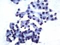 Salivary gland FNA图4
