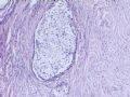 卵巢肿瘤图4