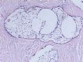 卵巢肿瘤图7