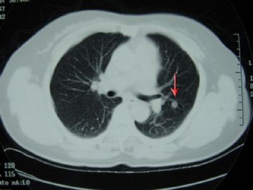 41岁女性,多发肺内,胸壁小结节.图1