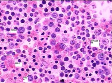 骨髓活检红系细胞特点图1