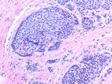 Invasive ductal ca look as DCIS-the importance of myoepithelial marker (cqz-10)图2