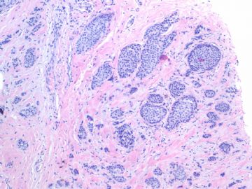 Invasive ductal ca look as DCIS-the importance of myoepithelial marker (cqz-10)图3