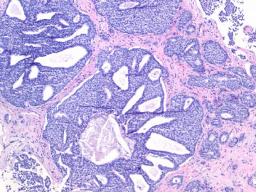 Invasive ductal ca look as DCIS-the importance of myoepithelial marker (cqz-10)图5