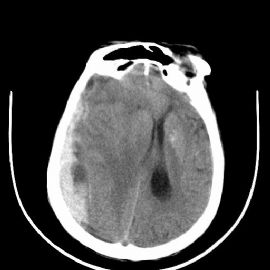 [090116]硬膜下血肿图1
