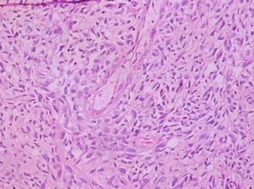 左额颞占位(会诊结果：星型胶质细胞瘤III级)图11