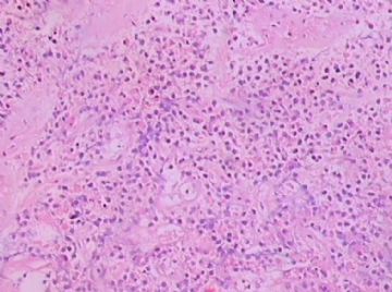 左额颞占位(会诊结果：星型胶质细胞瘤III级)图16