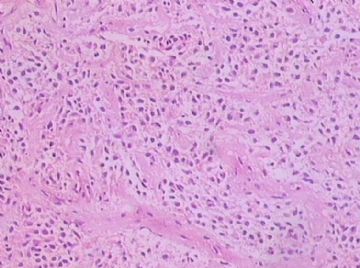 左额颞占位(会诊结果：星型胶质细胞瘤III级)图17
