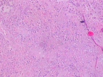 左额颞占位(会诊结果：星型胶质细胞瘤III级)图18