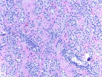 Breast LCIS involving sclerosing adenosis+ADH (cqz 11)图2