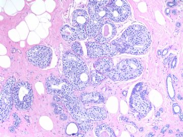 Breast LCIS involving sclerosing adenosis+ADH (cqz 11)图3