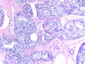 Breast LCIS involving sclerosing adenosis+ADH (cqz 11)图4