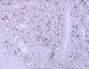 子宫肌瘤手术切除，有乳腺癌病史3年图5