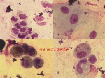 痰液抗酸染色 粉红色 是结核杆菌吗？急求答案？图1