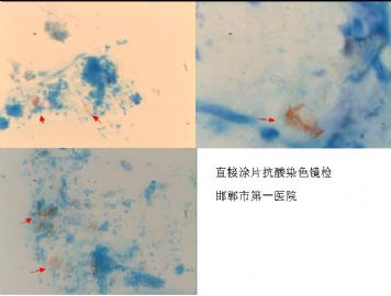 痰液抗酸染色 粉红色 是结核杆菌吗？急求答案？图2