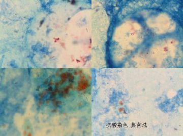 痰液抗酸染色 粉红色 是结核杆菌吗？急求答案？图3