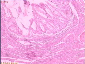 子宫内膜癌 一侧输卵管图1