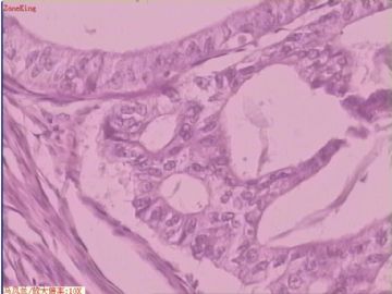 子宫内膜癌 一侧输卵管图3