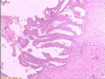 子宫内膜癌 一侧输卵管图4