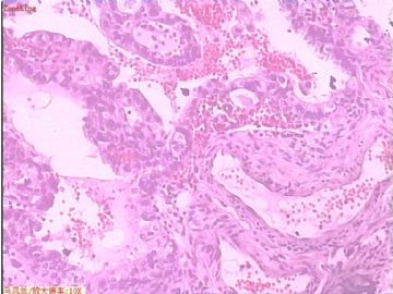子宫内膜癌 一侧输卵管图7