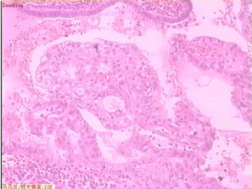 子宫内膜癌 一侧输卵管图8