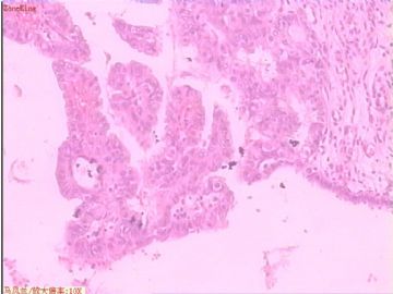 子宫内膜癌 一侧输卵管图9