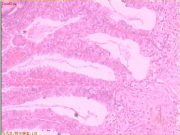 子宫内膜癌 一侧输卵管图12