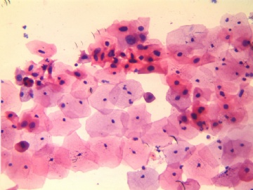 28岁，传统涂片，宫颈中度糜烂。图1