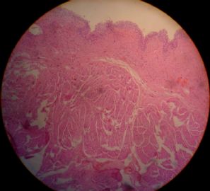 膀胱内壁肿物图2