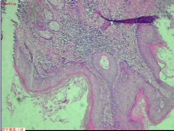 是角化棘皮瘤,还是鳞状细胞癌?图9