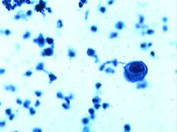 新手请教各位老：51岁宫颈肥大、中度糜烂图6