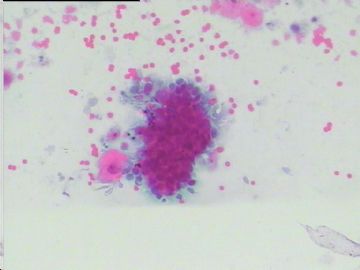 染色不好的腺细胞，如何好出报告啊？宫颈传统涂片，49岁图1