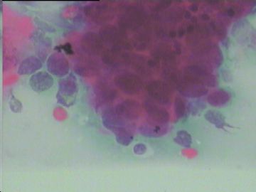 染色不好的腺细胞，如何好出报告啊？宫颈传统涂片，49岁图2