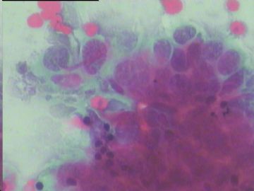 染色不好的腺细胞，如何好出报告啊？宫颈传统涂片，49岁图3