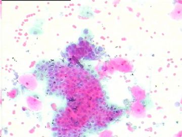 染色不好的腺细胞，如何好出报告啊？宫颈传统涂片，49岁图4