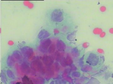 染色不好的腺细胞，如何好出报告啊？宫颈传统涂片，49岁图5