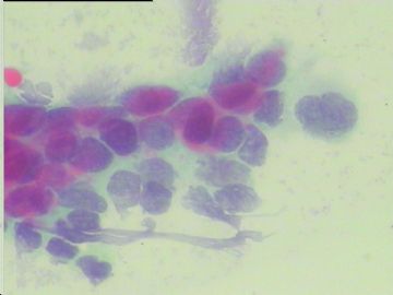 染色不好的腺细胞，如何好出报告啊？宫颈传统涂片，49岁图6