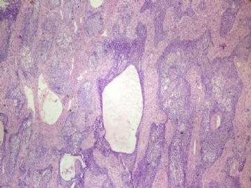 【已确诊】钙化性巢状-间质上皮肿瘤图1