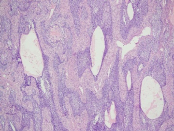 【已确诊】钙化性巢状-间质上皮肿瘤图2