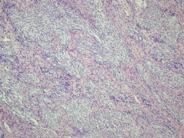 【已确诊】钙化性巢状-间质上皮肿瘤图3