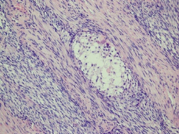 【已确诊】钙化性巢状-间质上皮肿瘤图4