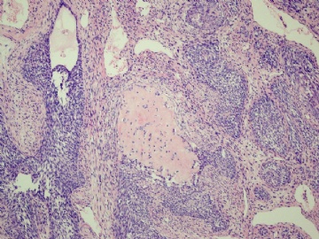 【已确诊】钙化性巢状-间质上皮肿瘤图5