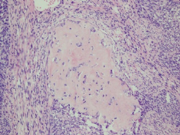 【已确诊】钙化性巢状-间质上皮肿瘤图6