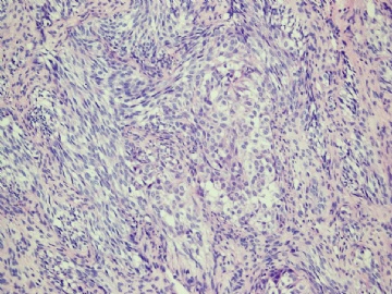 【已确诊】钙化性巢状-间质上皮肿瘤图7