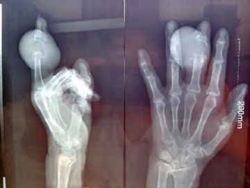 发生于手指的骨巨细胞瘤图1