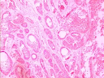 口腔颗粒细胞肌母细胞瘤图1