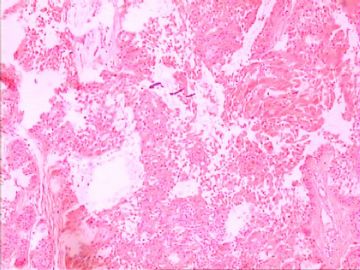 口腔颗粒细胞肌母细胞瘤图2