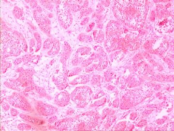 口腔颗粒细胞肌母细胞瘤图3