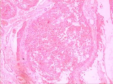口腔颗粒细胞肌母细胞瘤图4